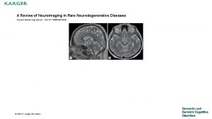 A Review of Neuroimaging in Rare Neurodegenerative Diseases