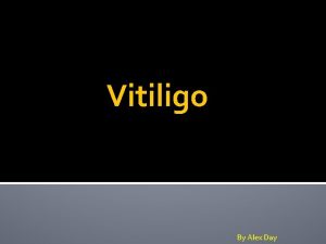 Vitiligo By Alex Day Vitiligo Vitiligo is a