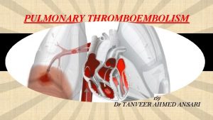 PULMONARY THROMBOEMBOLISM By Dr TANVEER AHMED ANSARI DEFINITION