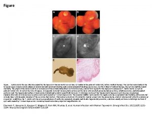 Figure Cysticercosislike eye infection caused by the tapeworm