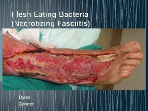 Flesh Eating Bacteria Necrotizing Fasciitis Dylan Connor Necrotizing