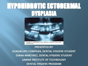 HYPOHIDROTIC ECTODERMAL DYSPLASIA PRESENTED BY GUADALUPE COMPEAN DENTAL