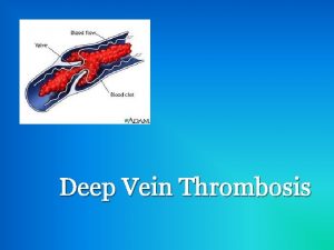 Deep Vein Thrombosis What is it A deep