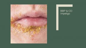 BBP CD Impetigo BBP CD Impetigo a bacterial