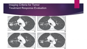 Imaging Criteria for Tumor Treatment Response Evaluation RECIST