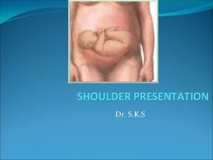 SHOULDER PRESENTATION Dr S K S Shoulder presentation