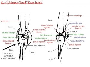 Rx Unhappy Triad Knee Injury quadriceps femur quadriceps