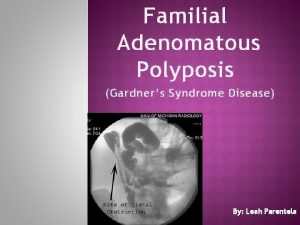 Familial Adenomatous Polyposis Gardners Syndrome Disease By Leah