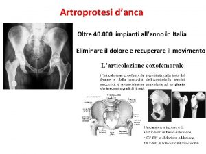 Artroprotesi danca Oltre 40 000 impianti allanno in