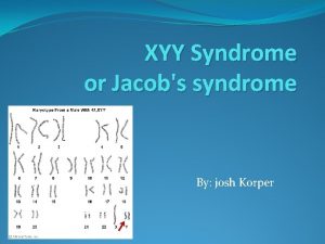 XYY Syndrome or Jacobs syndrome By josh Korper