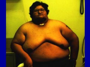 Obesity An excess of body fat body mass