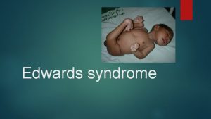 Edwards syndrome History Edwards syndrome was named after