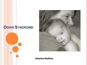 DOWN SYNDROME Johanna Martinez What causes Down Syndrome