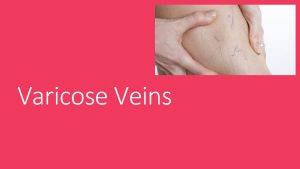 Varicose Veins 5 C Esa Erlinda Intan Septin