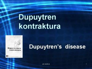 Dupuytren kontraktura Dupuytrens disease 182022 alen vukeli dr