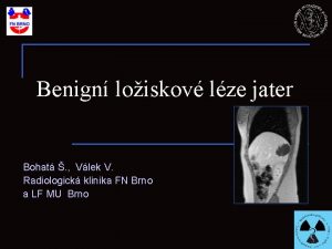 Benign loiskov lze jater Bohat Vlek V Radiologick