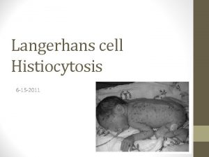 Langerhans cell Histiocytosis 6 15 2011 Case Presentation
