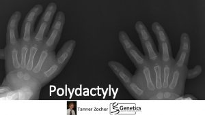 Polydactyly Tanner Zocher What is polydactyly Preaxial Postaxial