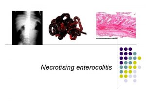 Necrotising enterocolitis Introduction l Necrotizing enterocolitis NEC is