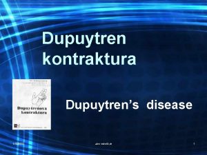 Dupuytren kontraktura Dupuytrens disease 1102022 alen vukeli dr