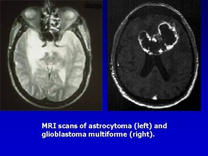 MRI scans of astrocytoma left and glioblastoma multiforme