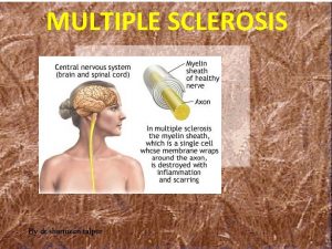 MULTIPLE SCLEROSIS By dr sharmeen talpur Name of
