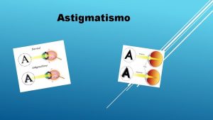 Astigmatismo Introduo O astigmatismo se caracteriza pela formao