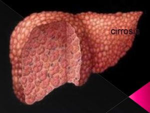 cirrosis Cirrosis Heptica Es una enfermedad crnica difusa