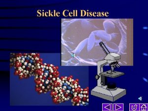 Sickle Cell Disease Sickle Cell Disease James R