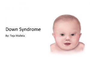Down Syndrome By Teja Mallela Down Syndrome An