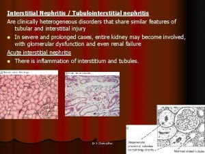 Interstitial Nephritis Tubulointerstitial nephritis Are clinically heterogeneous disorders