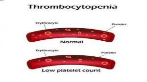DEFINITION Thrombocytopenia is a condition characterized by abnormally