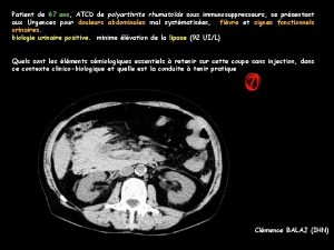 Patient de 67 ans ATCD de polyarthrite rhumatode