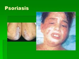 Psoriasis What is psoriasis Psoriasis is a noncontagious