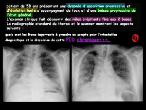 patient de 58 ans prsentant une dyspne dapparition