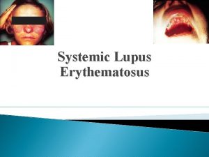 Systemic Lupus Erythematosus History of Lupus Lupus means