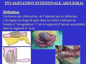 INVAGINATION INTESTINALE AIGUEIIA Dfinition Occlusion par obstruction de