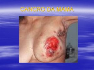 CANCRO DA MAMA INTRODUO O cancro da mama