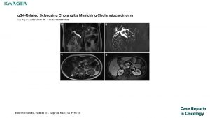 Ig G 4 Related Sclerosing Cholangitis Mimicking Cholangiocarcinoma