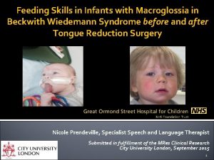 Feeding Skills in Infants with Macroglossia in Beckwith