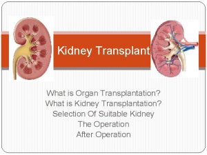 Kidney Transplant What is Organ Transplantation What is