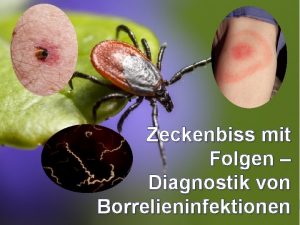 Zeckenbiss mit Folgen Diagnostik von Borrelieninfektionen LymeBorreliose 1975