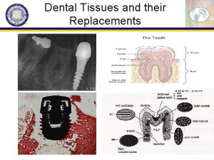 Dental Tissues and their Replacements Issues Dental decay