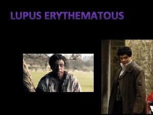 What is lupus erythematous Lupus erythematous is a