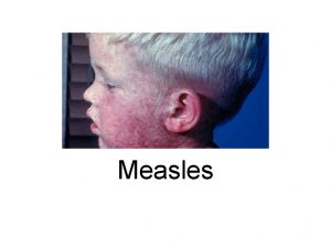 Measles Etiology Measles virus is a spherical nonsegmented