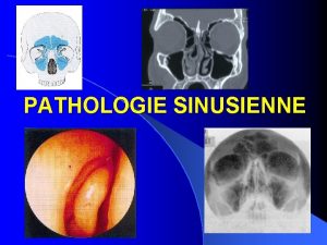 PATHOLOGIE SINUSIENNE ANATOMIE DES CAVITES RHINO SINUSIENNES SINUS