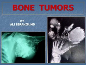 BONE TUMORS BY ALI IBRAHIM MD Bone tumors