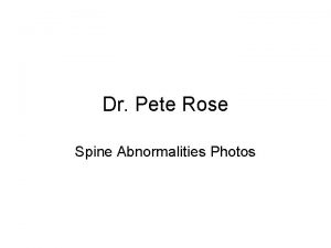 Dr Pete Rose Spine Abnormalities Photos Scoliosis Abnormal