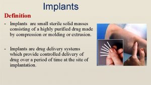 Implants Definition Implants are small sterile solid masses