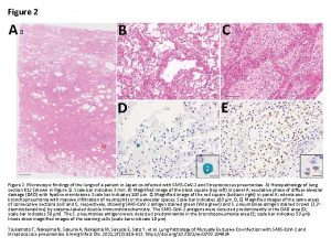 Figure 2 Microscopic findings of the lungs of